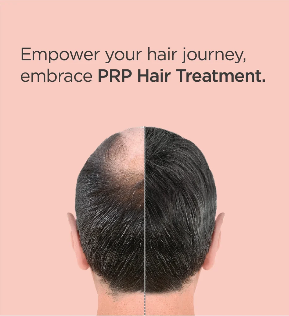 PRP Hair Treatment prp mobile hr 10