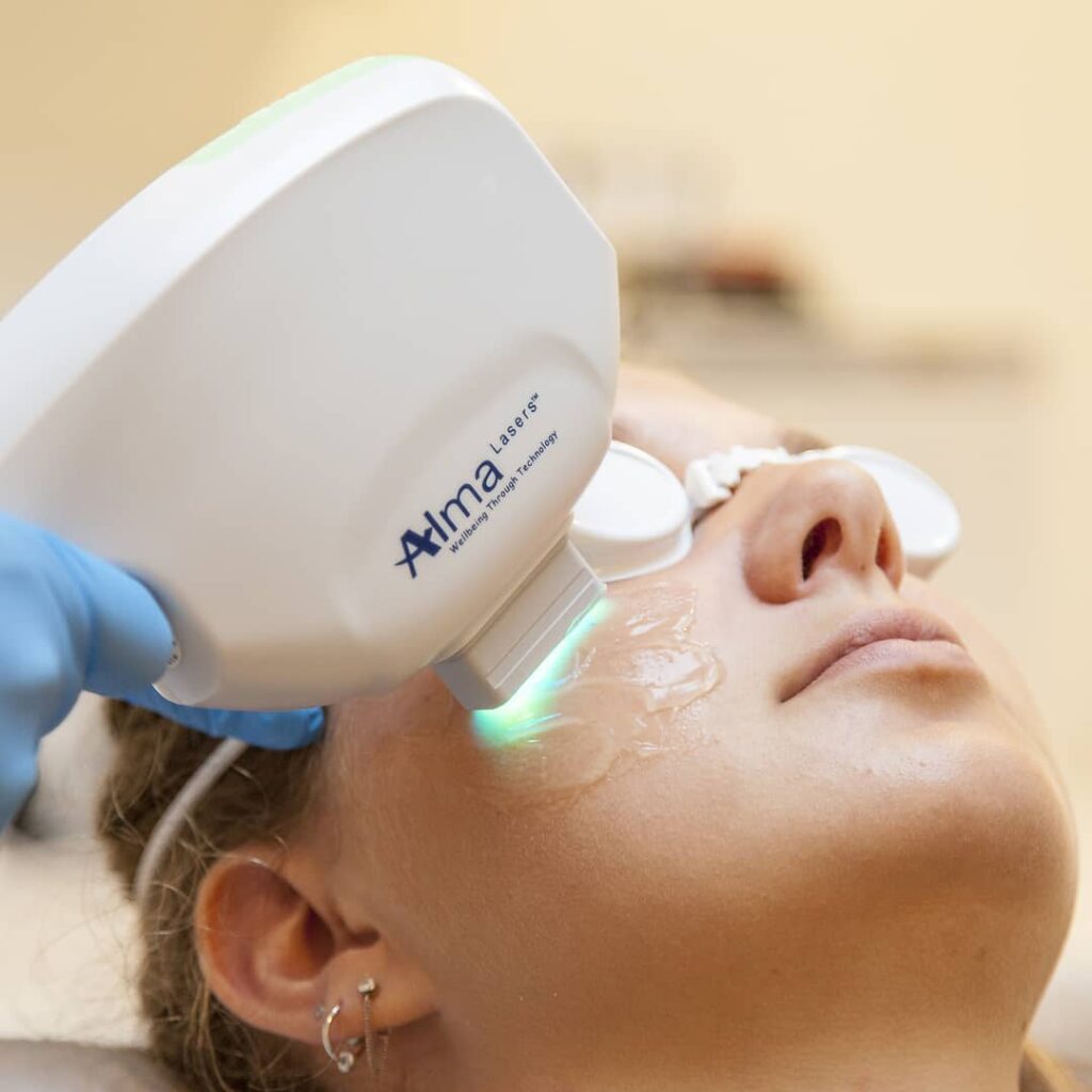 PhotoFacial photofacial treatment
