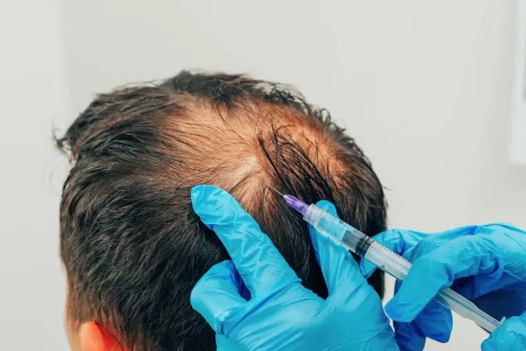 PRP Hair Treatment prp hair treatment success rate dr malay mehta